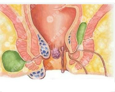 南寧哪個醫(yī)院可以做肛周膿腫？