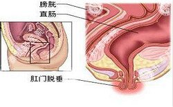 南寧治療脫肛哪家醫(yī)院好？南寧脫肛治療多少錢？